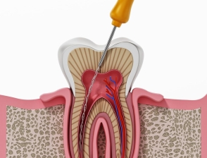 Điều Trị Tủy Răng 1 Chân