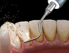Cạo Vôi Răng Gói Số 1