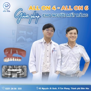 hanh-trinh-lay-lai-nu-cuoi-sau-khi-trong-rang-implant