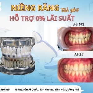 nieng-rang-tra-gop