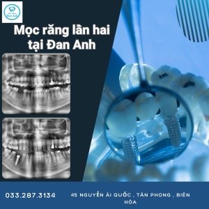 trong-rang-implant-moc-rang-vinh-vien-lan-2