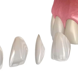 mat-dan-su-veneer-emax